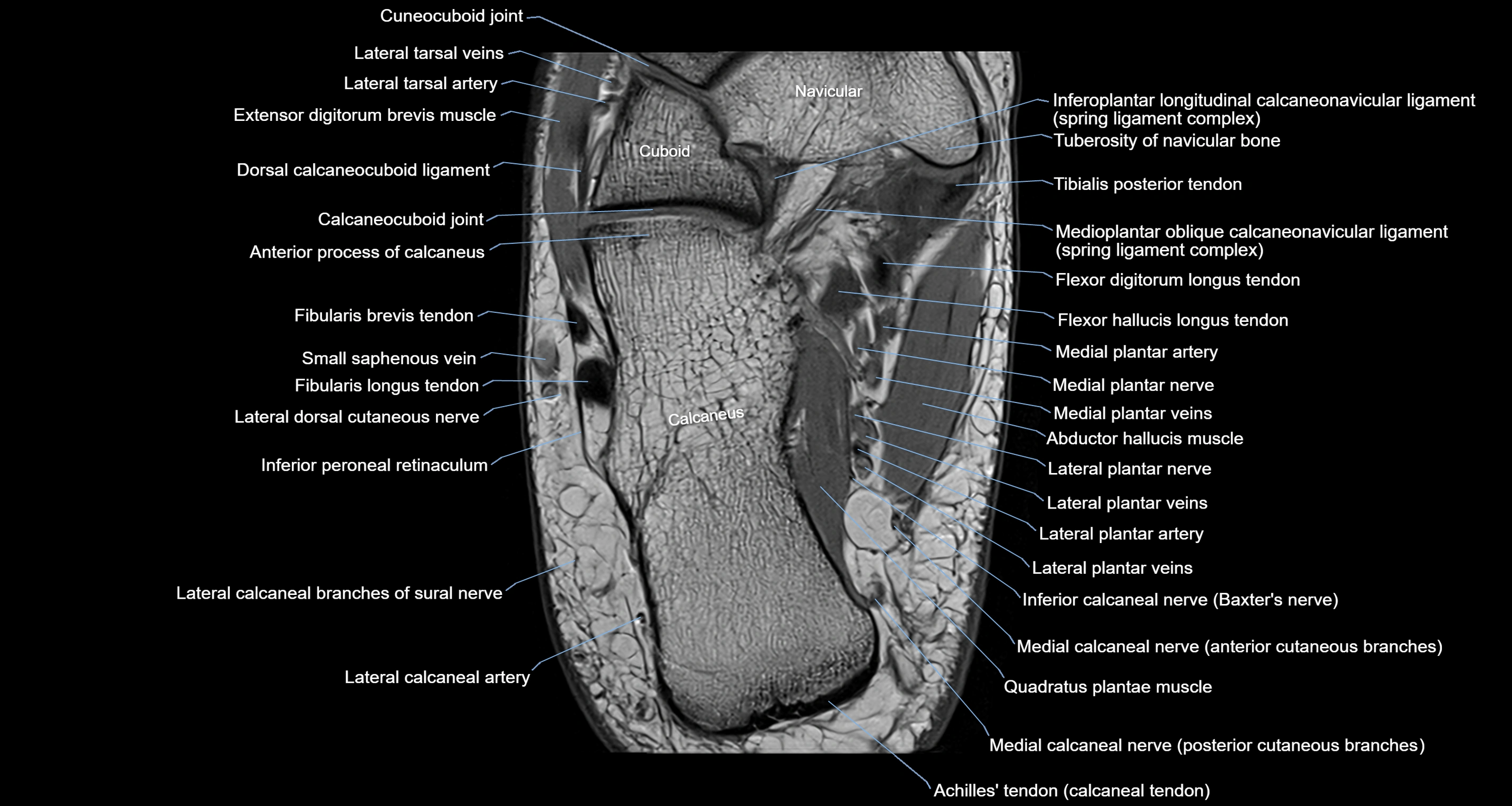 Ankle axial anatomy 3T MRI images -img-10001-00030.webp